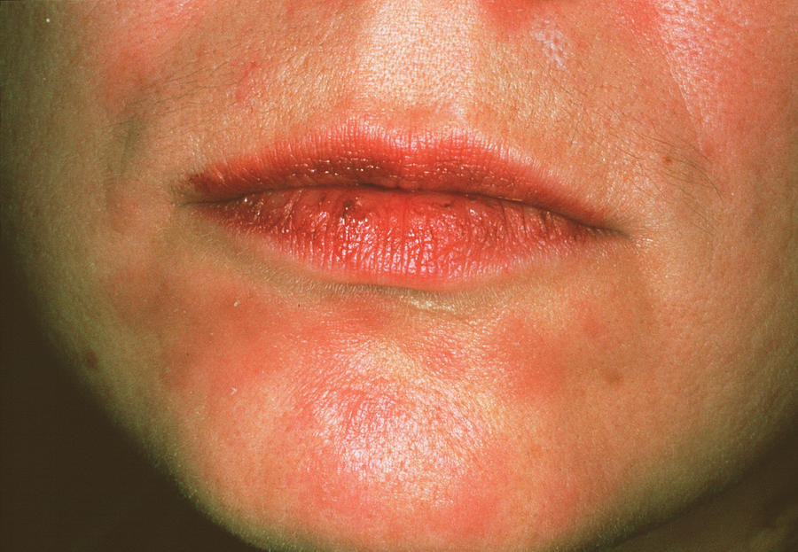 secondary-syphilis-rash-cnriscience-photo-library (1)